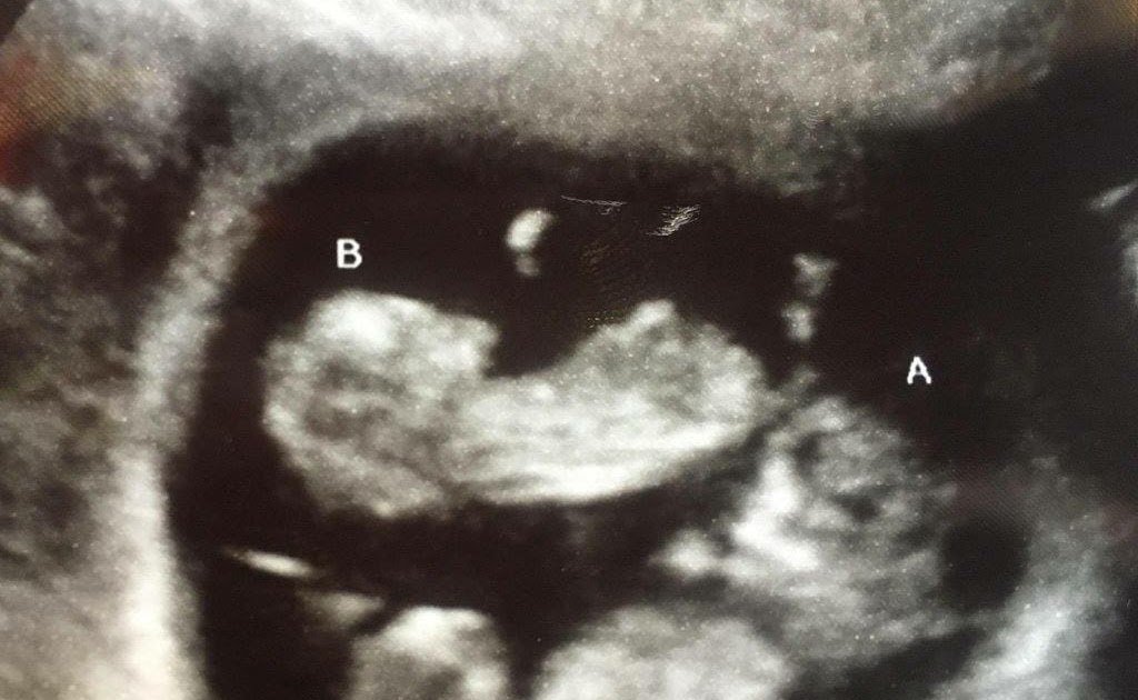 10 Week Ultrasound : Scientists Confirm: Blood Test Can Tell A Fetus