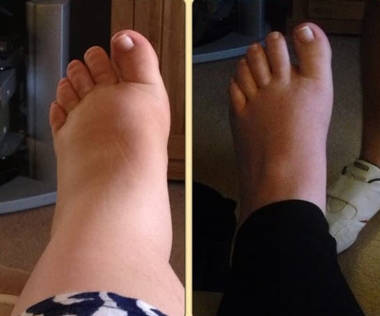 11 photos of pregnancy swelling: How do your feet compare ...