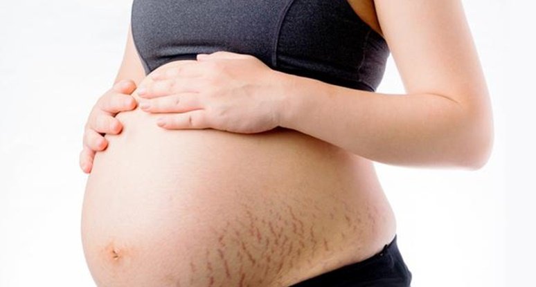 4 Easy Tips to Prevent Stretch Marks During Pregnancy ...