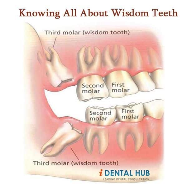 8 best images about The problem with wisdom teeth on Pinterest
