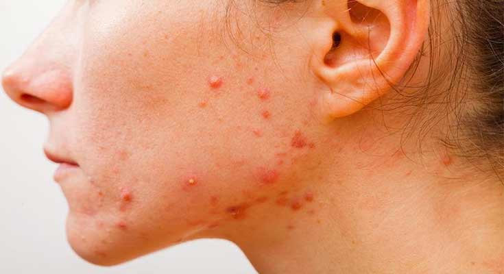 Acne during Pregnancy: Causes and home remedies