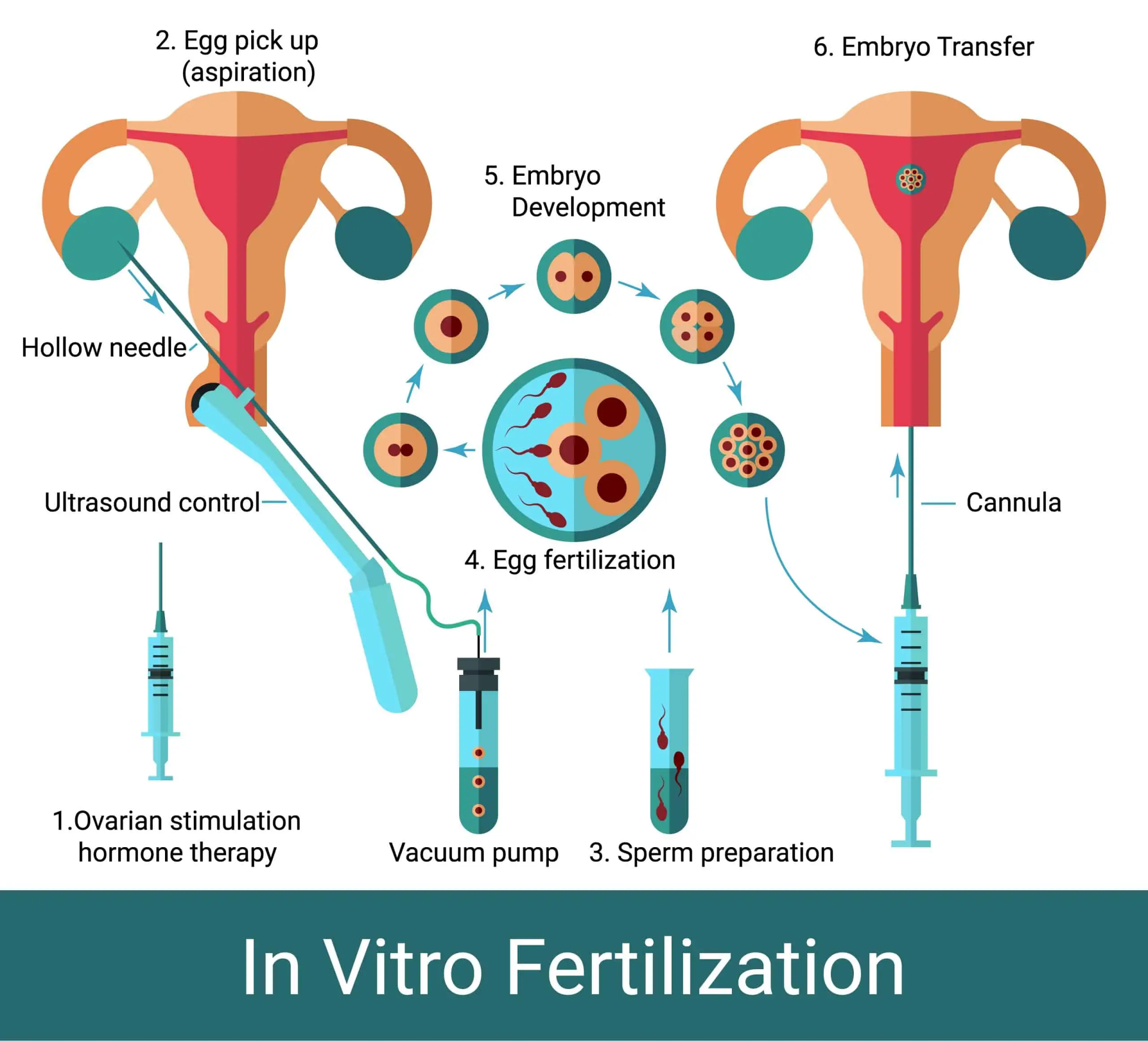 Affordable In Vitro Fertilization