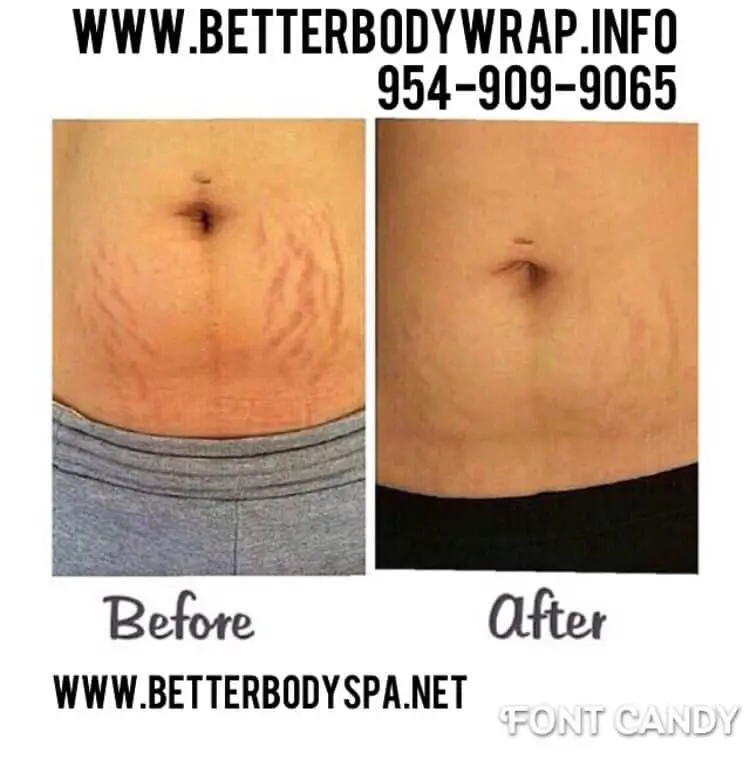 Before and after wraps for Stretch marks