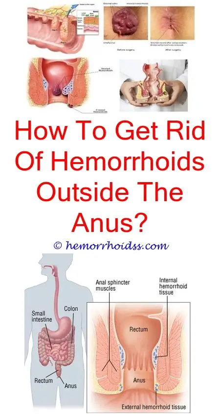 Can Hemorrhoids Cause Excessive Gas? how to treat internal hemorrhoids ...