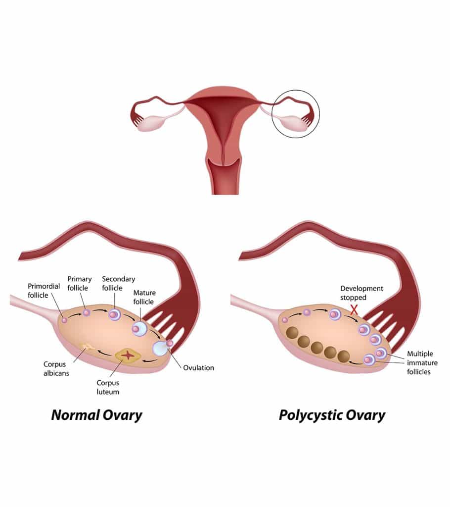 Can Ovarian Cysts Prevent Pregnancy?