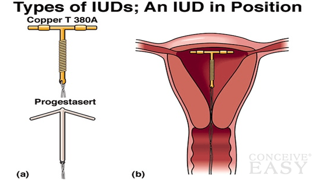 Can You Get Pregnant On The IUD?