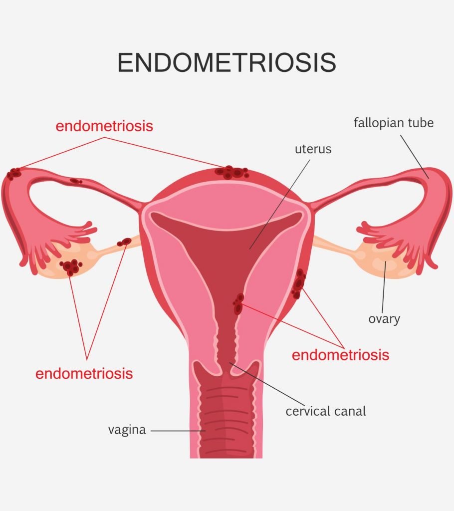 Can you get pregnant with endometriosis