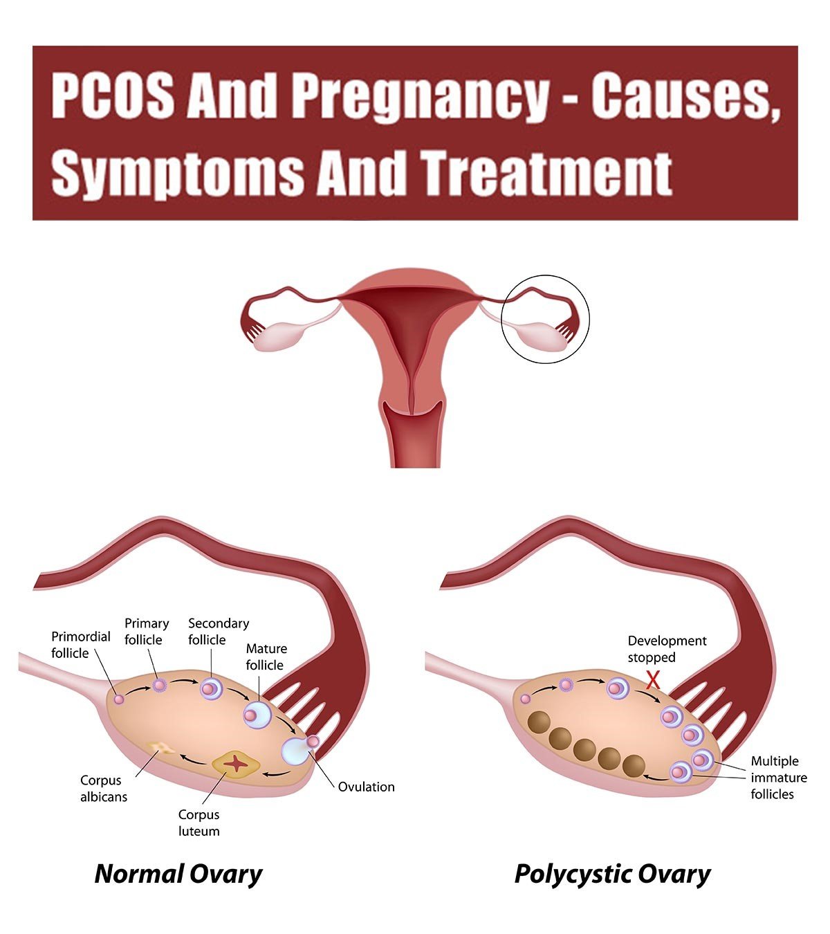 Can You Get Pregnant With PCOS?