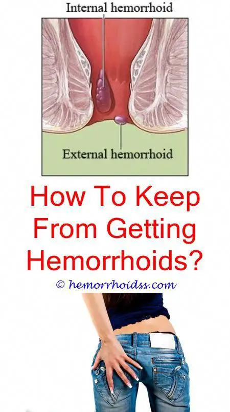 Can You Use Hemorrhoid Suppositories While Pregnant? what ...