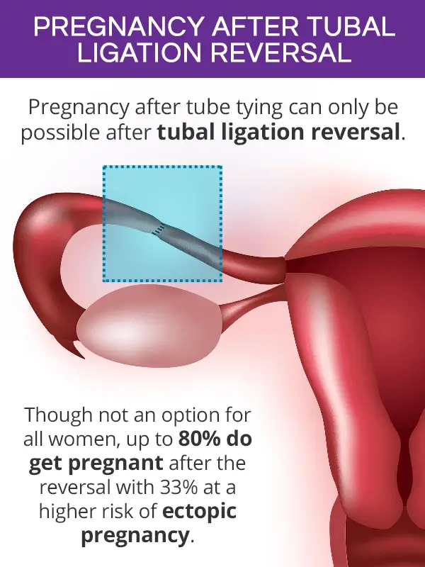 Chances of Getting Pregnant after Tubal Ligation