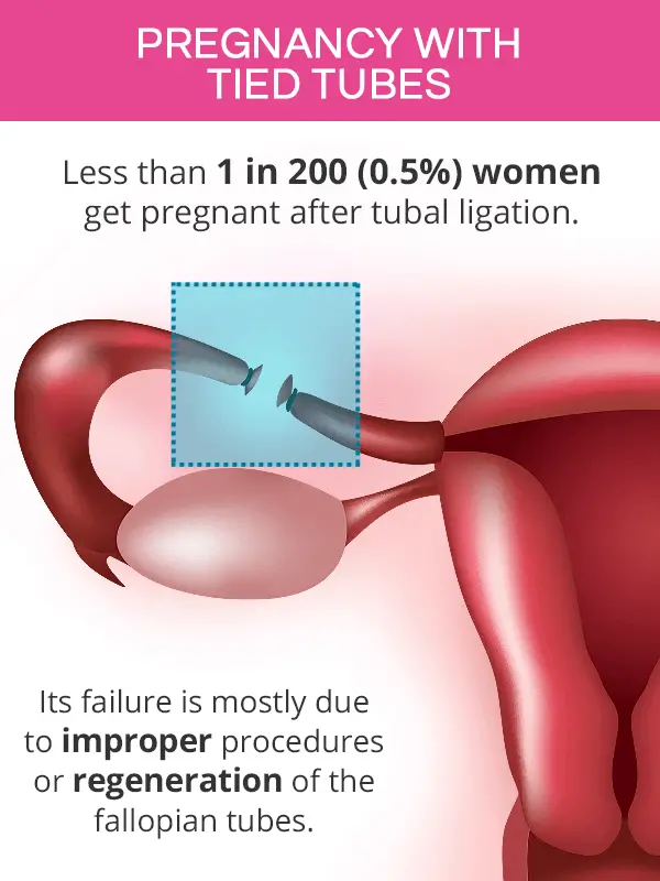 Chances Of Pregnancy After Tubal Ligation Reversal