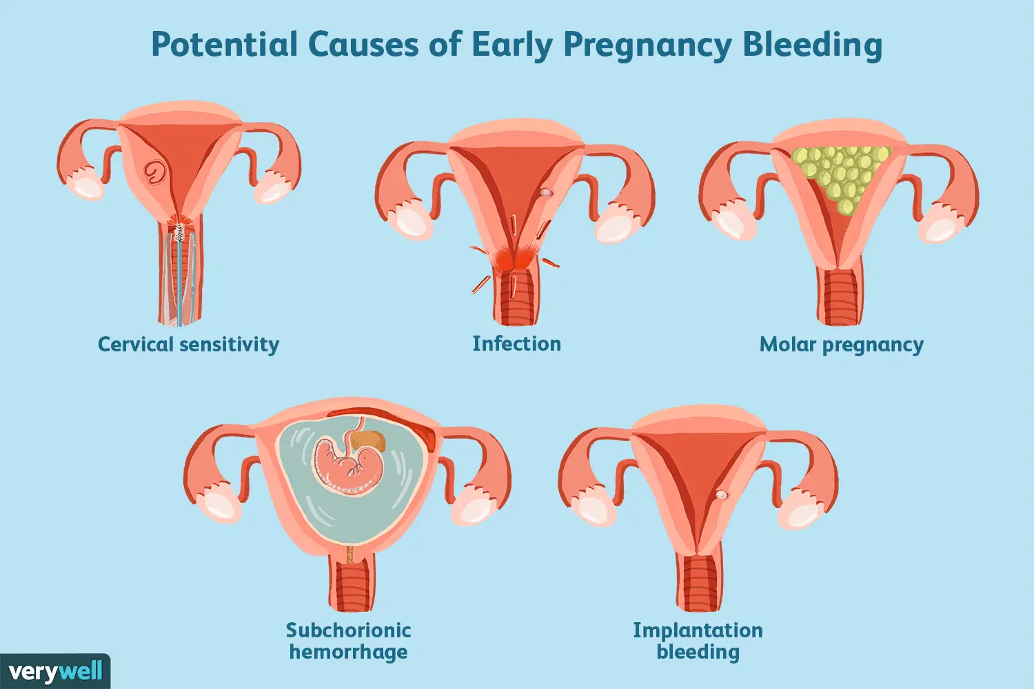 Does Early Pregnancy Bleeding Mean a Miscarriage?