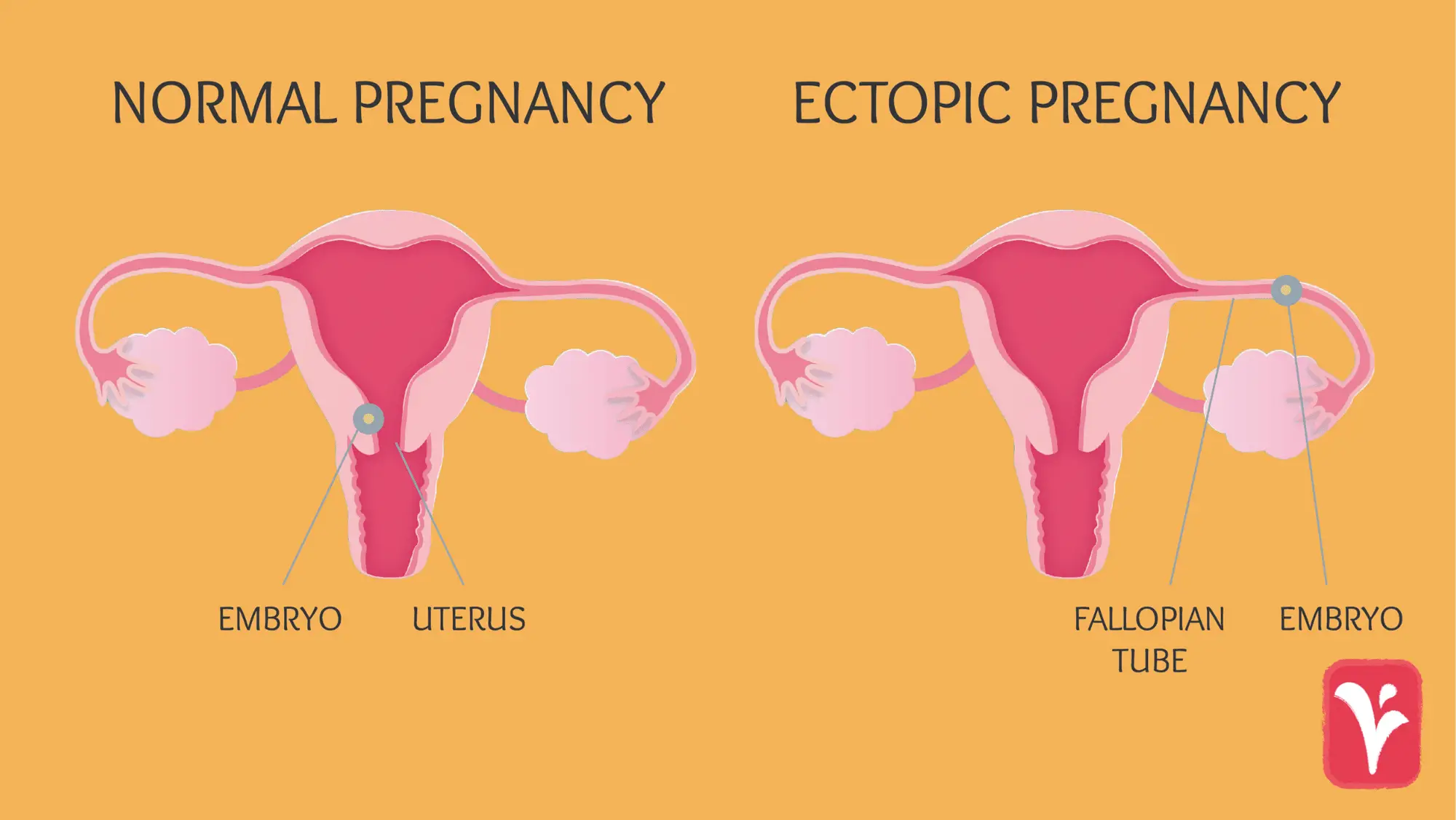 Ectopic Pregnancies: What You Need to Know