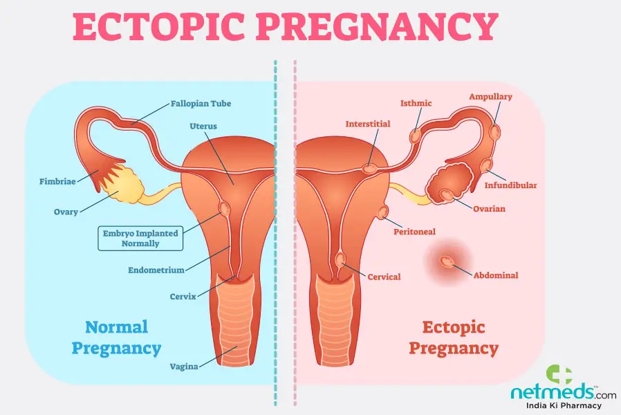 Ectopic Pregnancy: Causes, Symptoms and Treatment