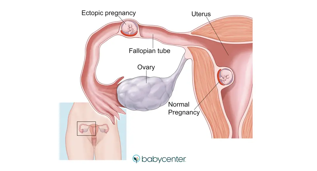 Ectopic pregnancy: Signs, treatments, causes, risk factors