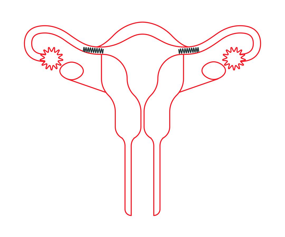 Fallopian Tubes Removed Still Have Period