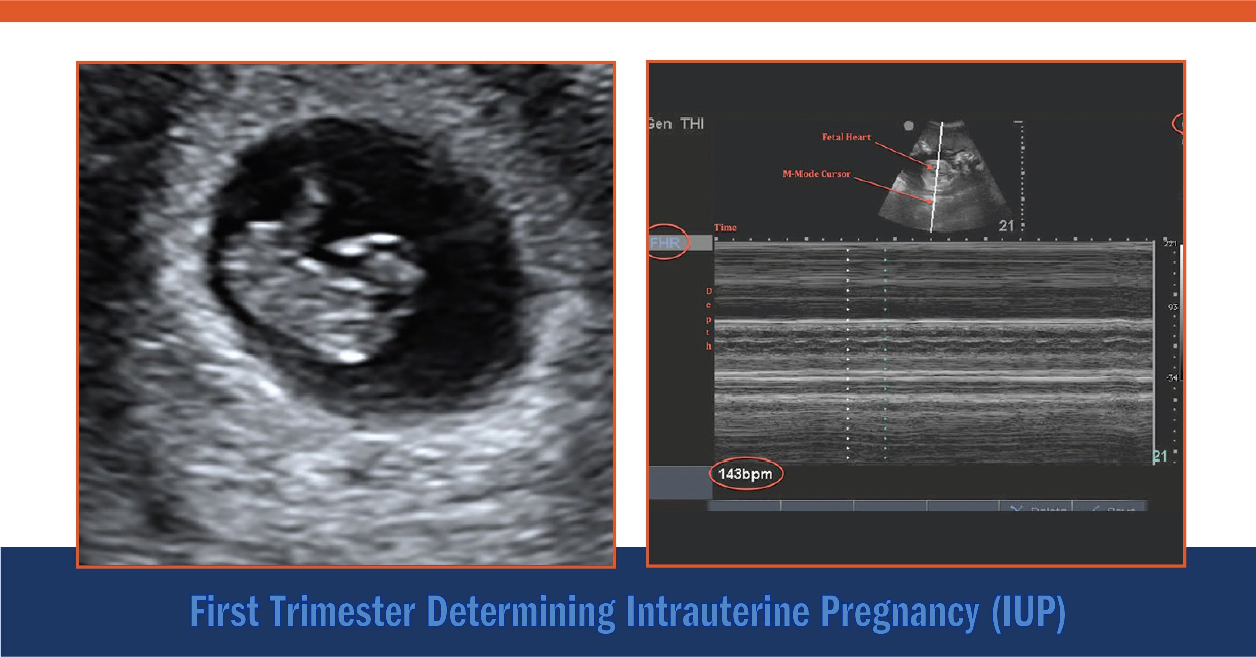 First Trimester: Determining Intrauterine Pregnancy (IUP)