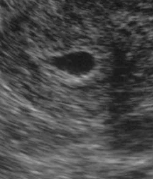 Four Weeks Pregnant Ultrasound