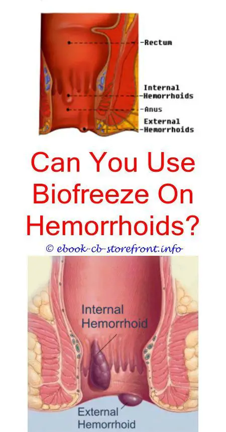 Hemorrhoids are commonly quite distressing, yet a little bit of ...