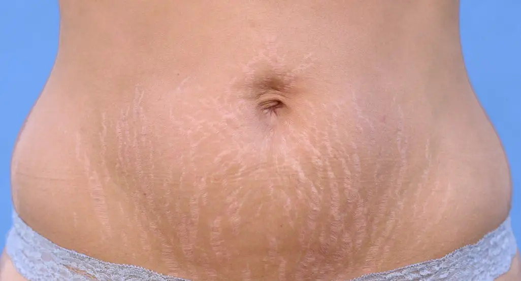 How can I get rid of stretch marks?