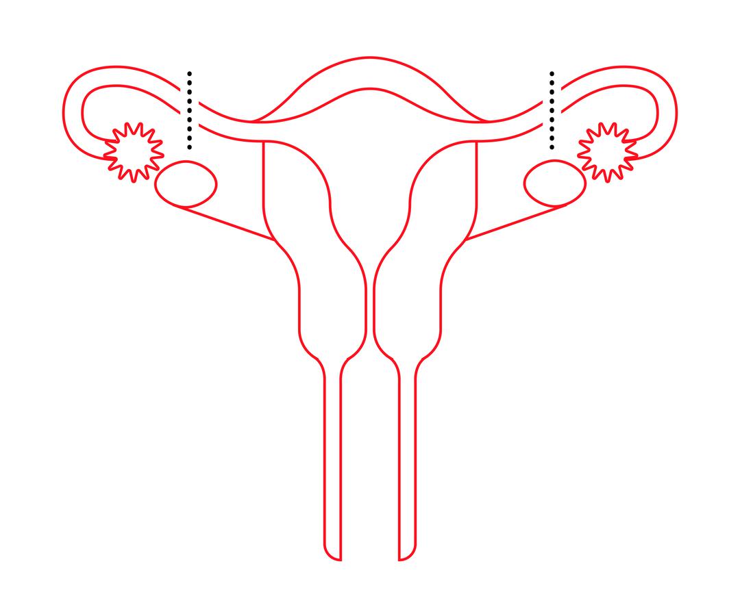 How Does Your Period Work After Tubal Ligation
