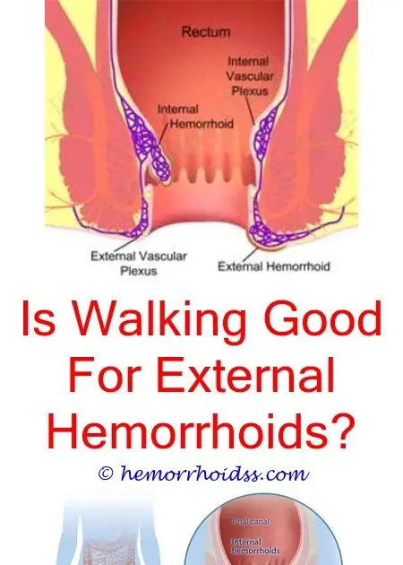 How Long Can External Hemorrhoids Last? how to heal ...