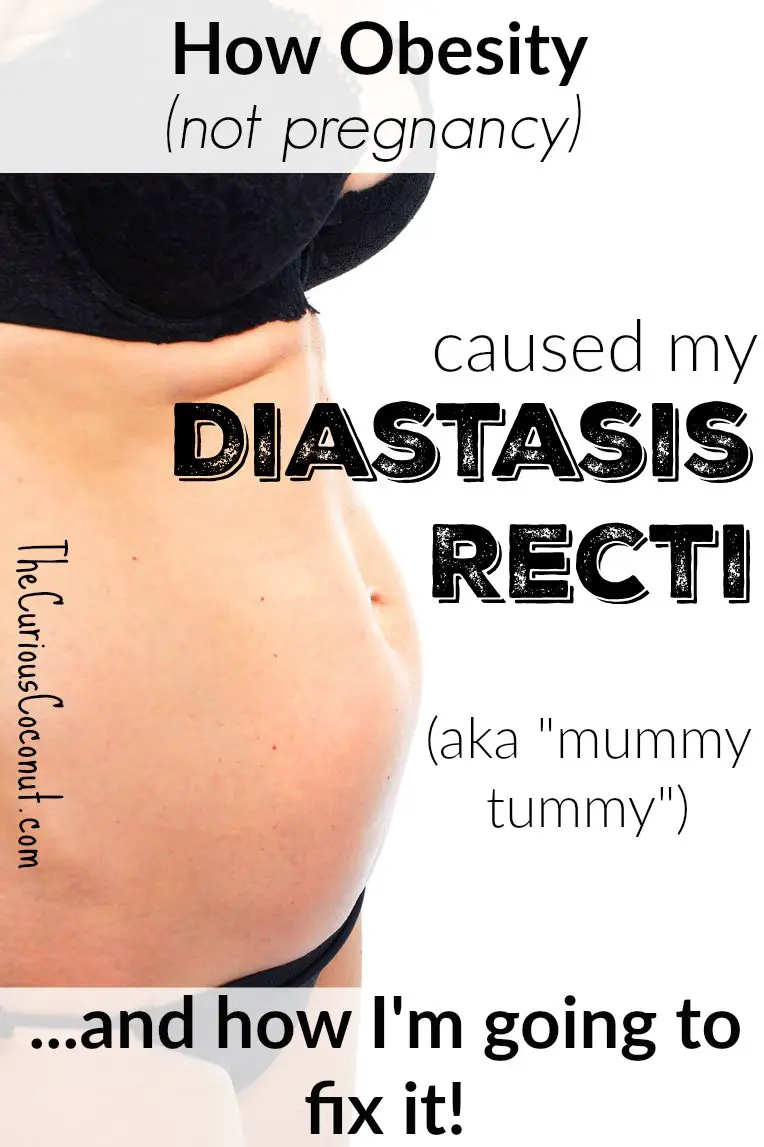 How Obesity Caused My Diastasis Recti  The Curious Coconut