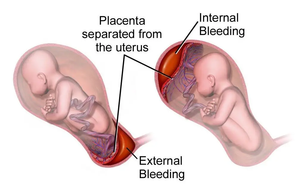 How Often Can You Bleed During Pregnancy