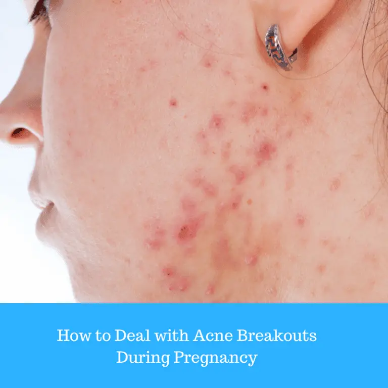 How to Deal with Acne Breakouts During Pregnancy
