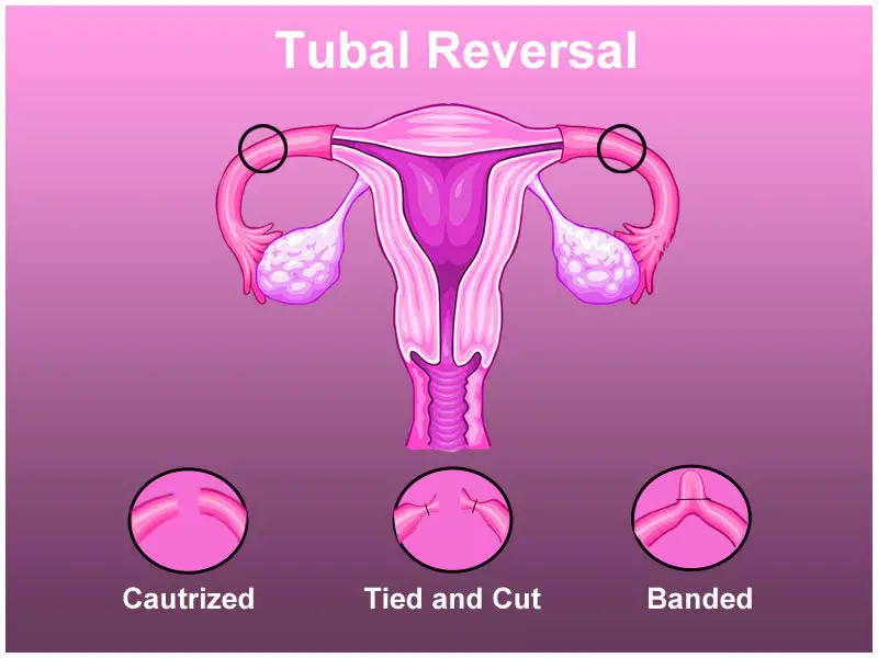 How To Get Pregnant With Tubal Ligation Without Surgery