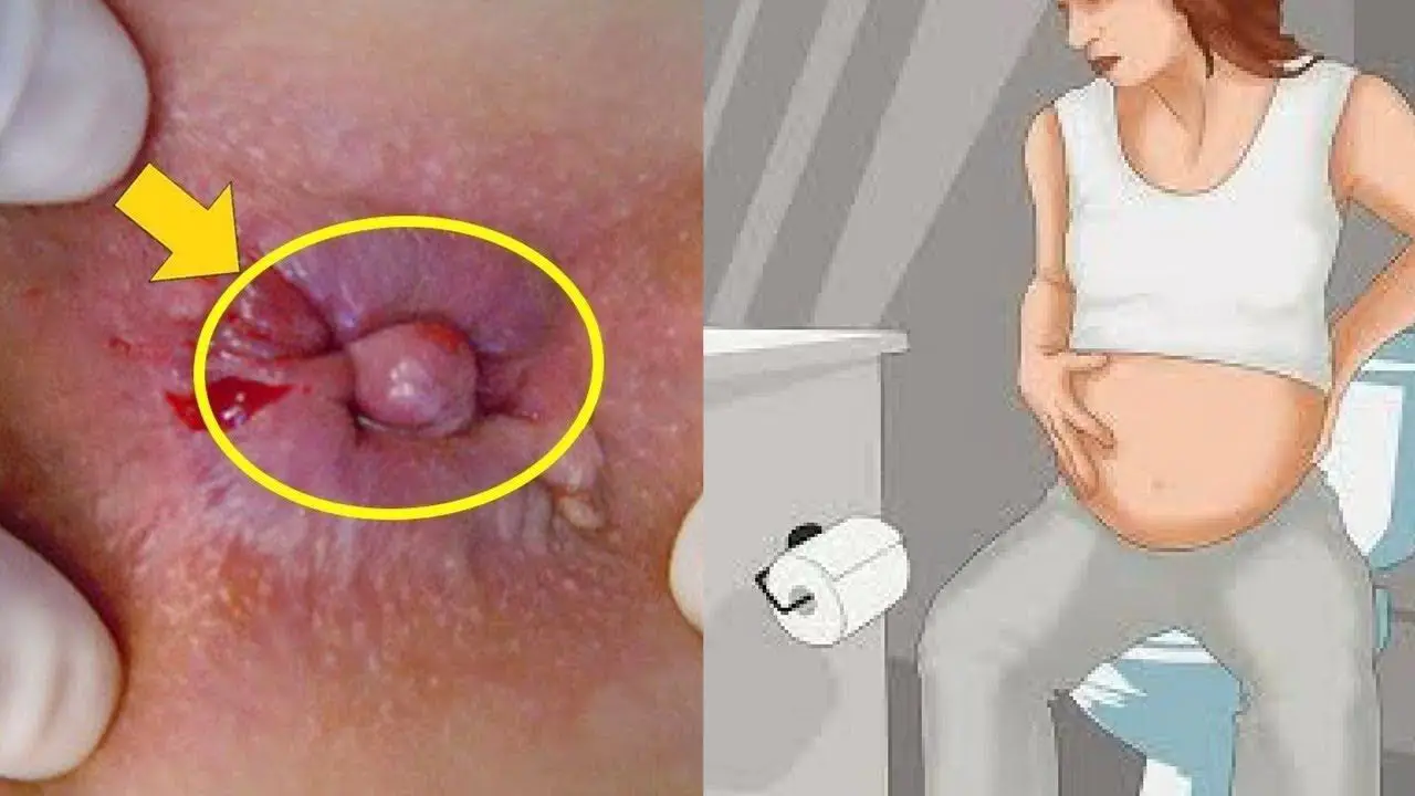 How To Get Relief From Hemorrhoids During Pregnancy