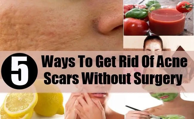 How To Get Rid Of Acne Scars Without Surgery