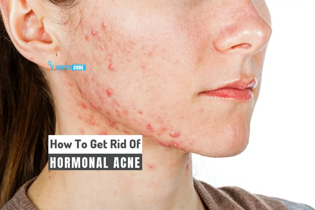 How To Get Rid Of Hormonal Acne In 5 Natural Ways At Home ...