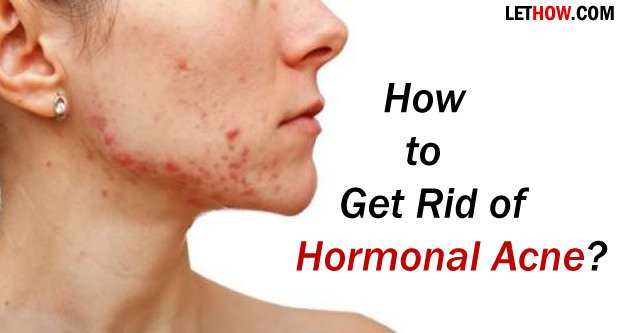 How to Get Rid of Hormonal Acne?