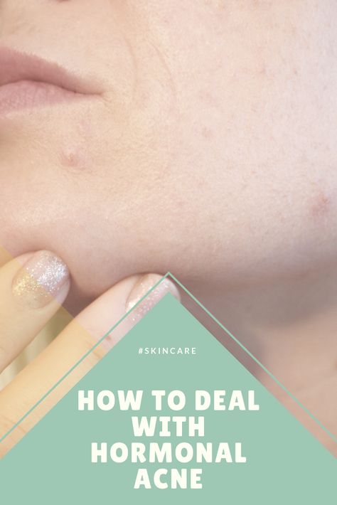 How to get your hormonal acne under control