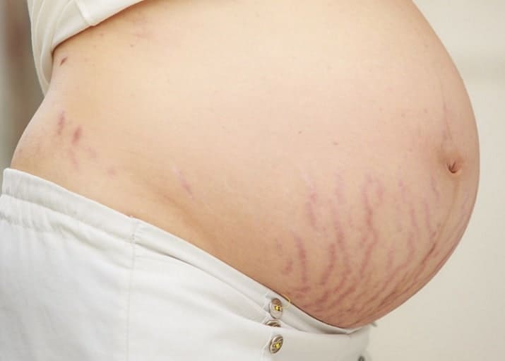 How to Prevent Pregnancy Stretch Marks â Causes ...