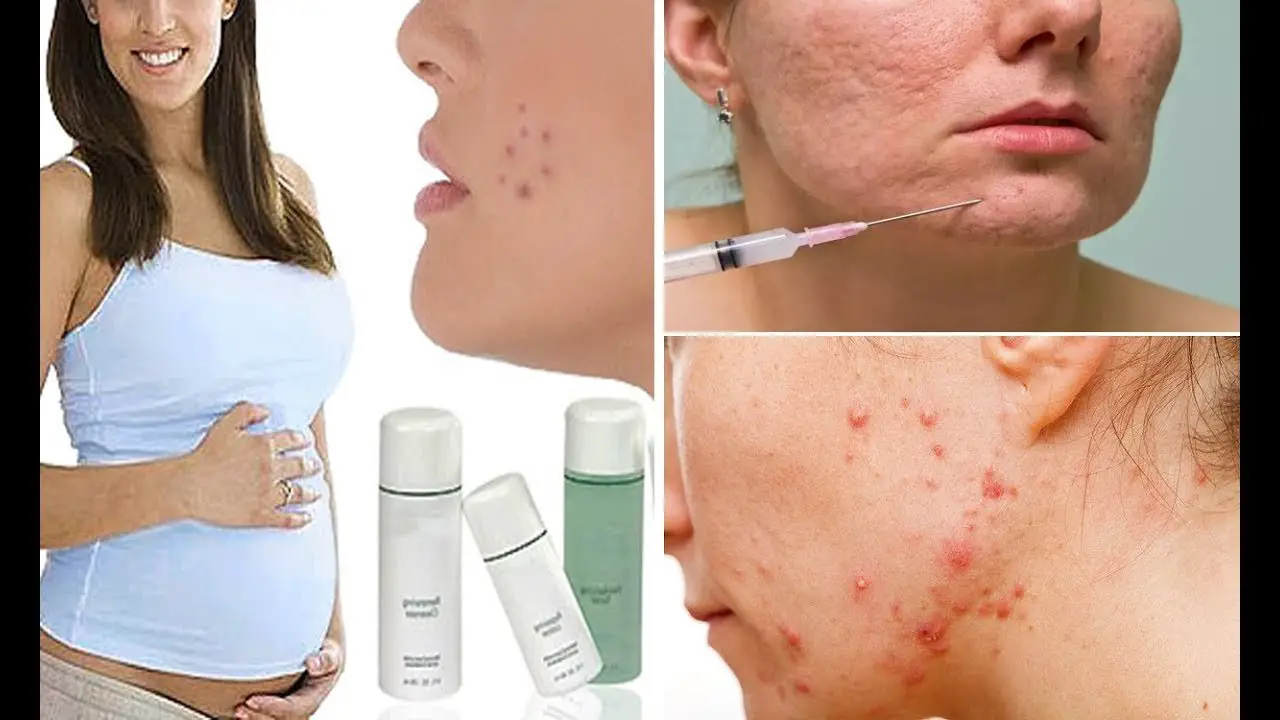 How to Treat Acne during Pregnancy