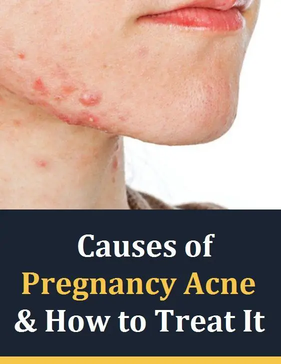 How To Treat Acne During Pregnancy