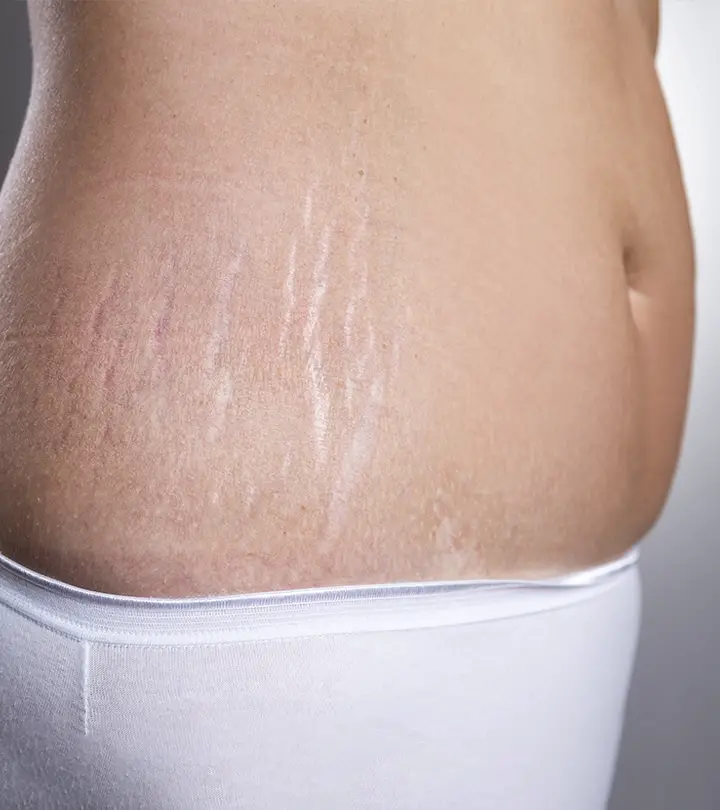 How To Treat Stretch Marks And Loose Skin
