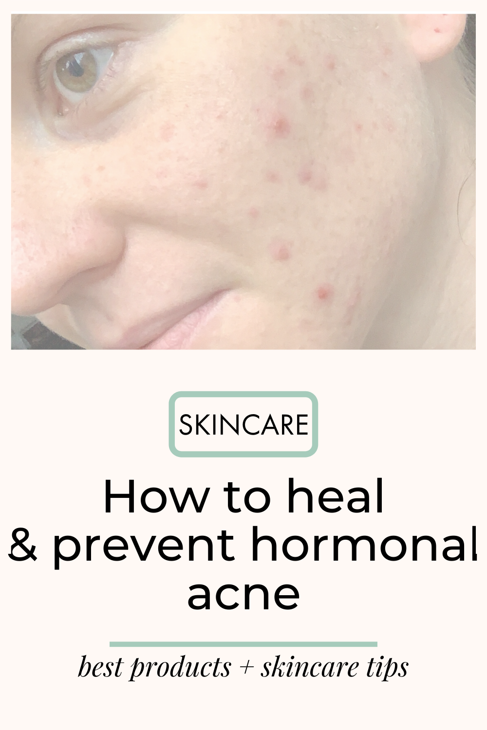 I spent 6 months experimenting with products to heal cystic acne ...