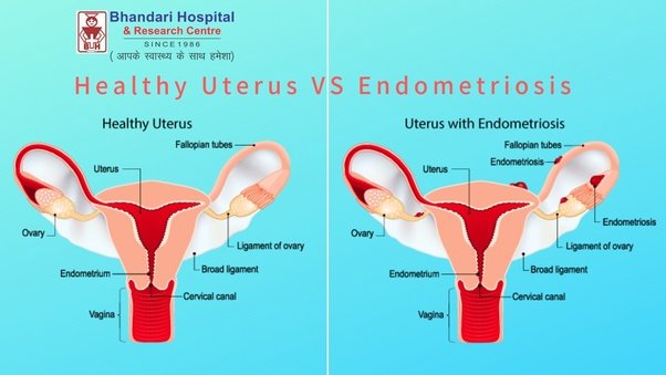 Is it possible to get pregnant if you have endometriosis ...