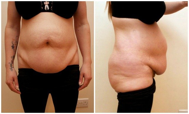 Is it possible to lose the mommy belly without a tummy tuck ...