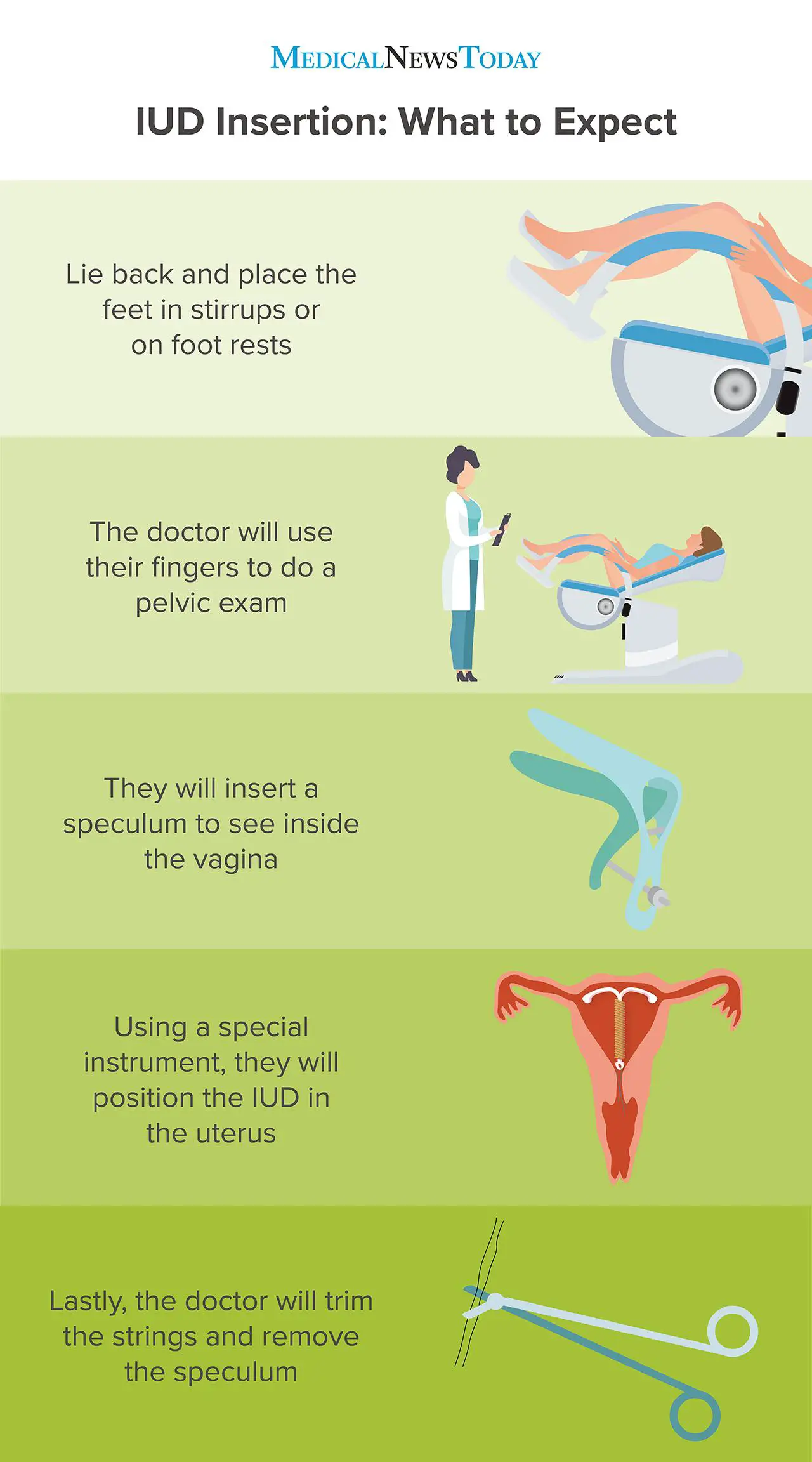 IUD insertion: A guide and what to expect