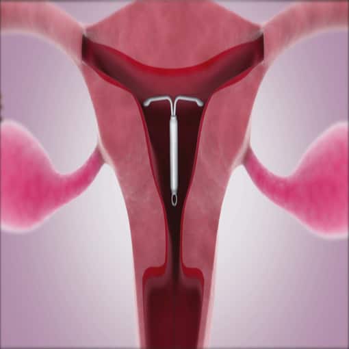 IUD most effective birth control method, Canadian pediatricians declare ...