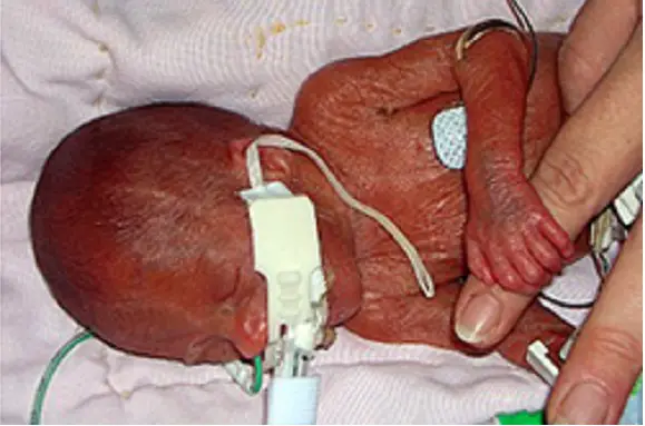 Jessica Was Born at Just Five Months, But Its Legal to ...