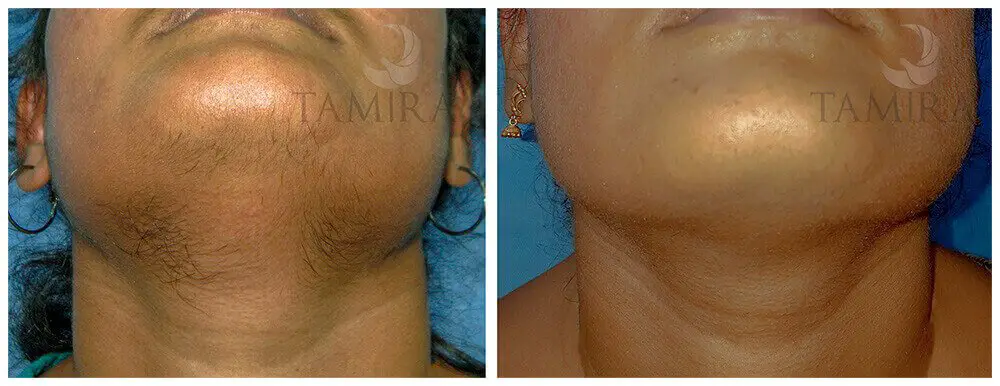 Laser Hair Removal in Chennai for Permanent Hair Reduction ...