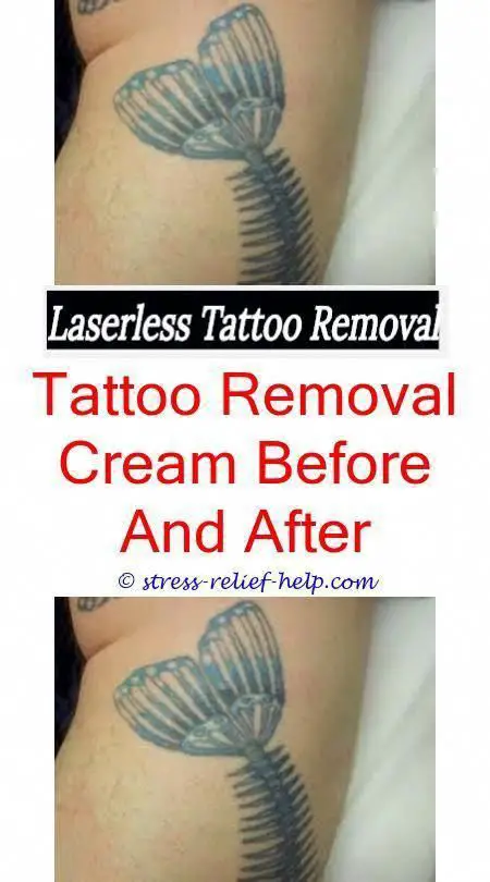Laser tattoo removal jobs.Can permanent tattoos be removed ...