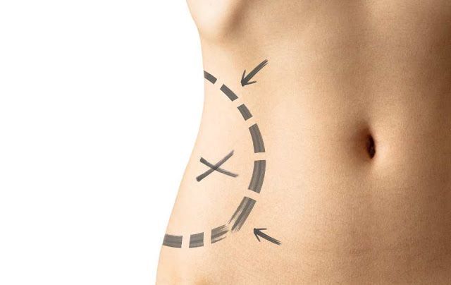 Lipo Laser Treatments for Weight Loss