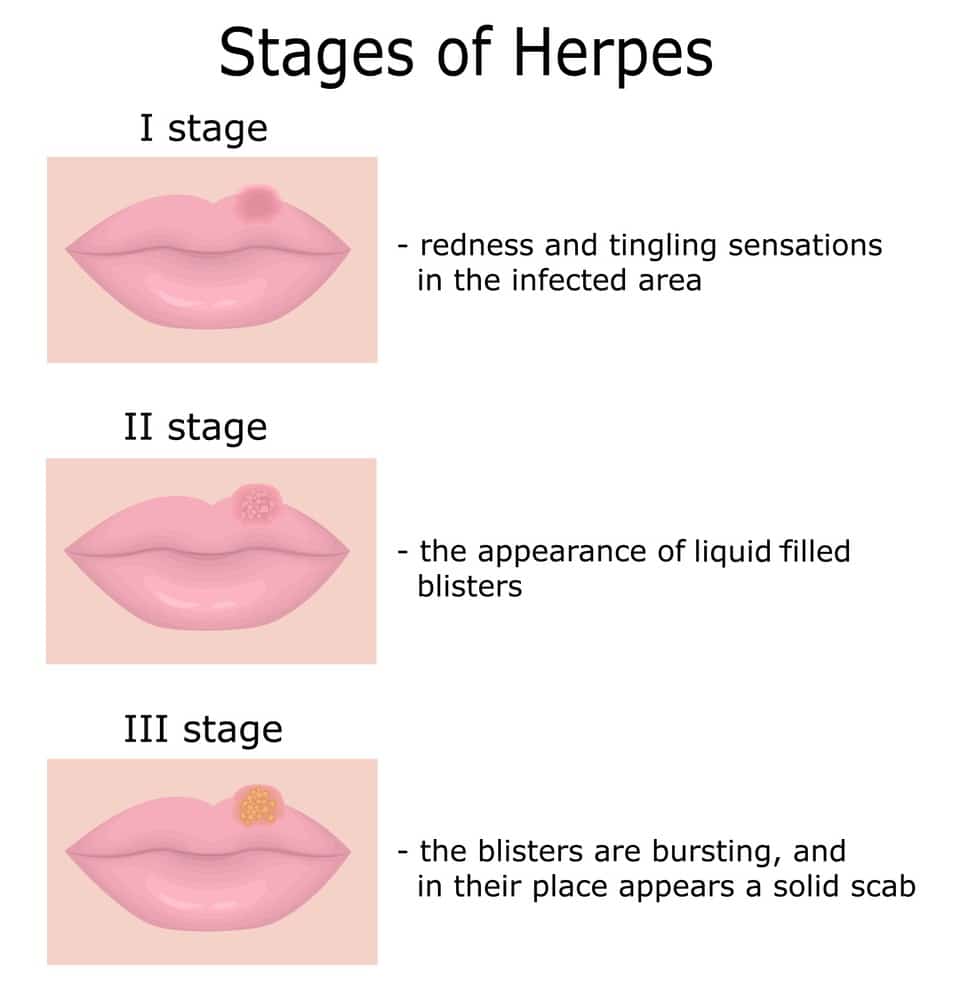 Living with Herpes