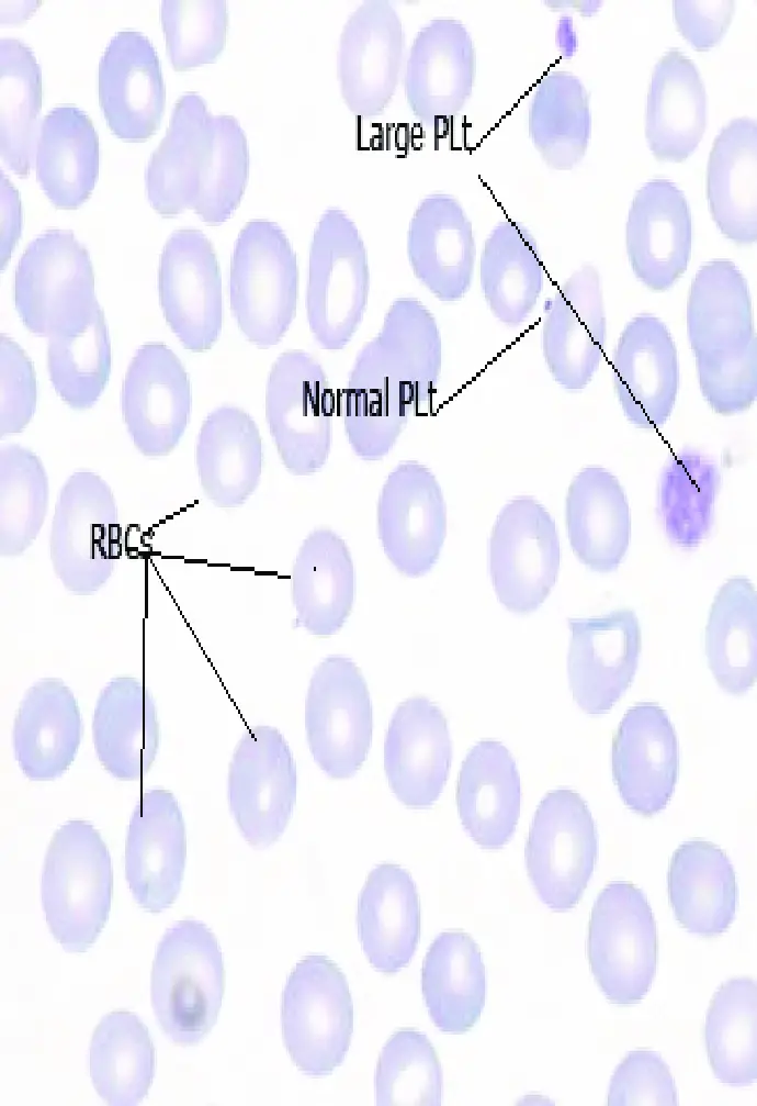 Low Platelets In Pregnancy Epidural